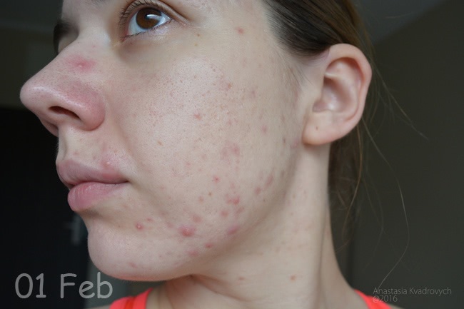SVR Lysalpha Cicapeel Gel - Пилинг для жирной и проблемной кожи