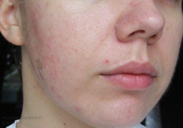Что делать если стянуло кожу на лице Что делать если стянуло кожу на лице