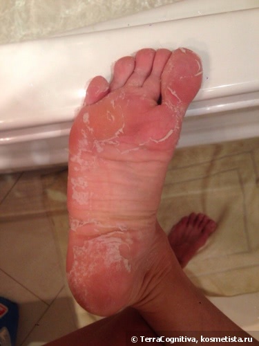 Спасение для проблемных ножек - отшелушивающая маска-носки для ног Skinlite Exfoliating Foot Mask