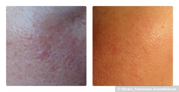 Помощь чувствительной коже с поврежденными капиллярами - Algologie Caress Day Cream
