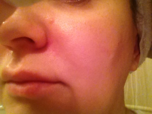 Химический пилинг дома с BеаutyMed Peel Therapy Glycolic Acid Complex