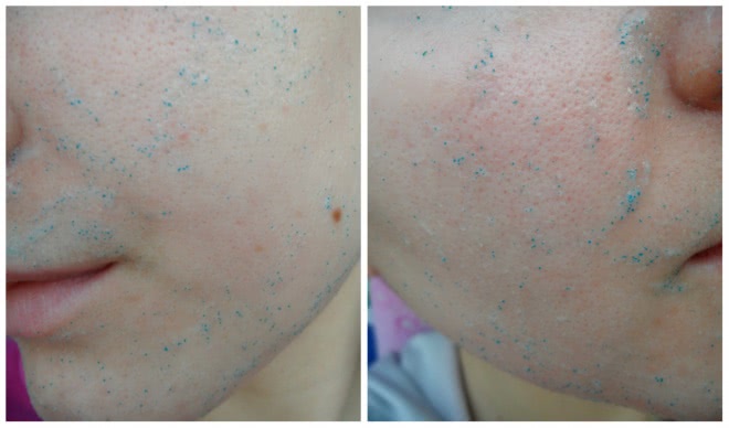 Парочка от Noreva Exfoliac. Борцы с несовершенствами кожи, которые не справились