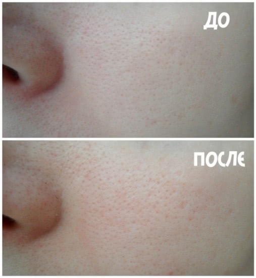 Парочка от Noreva Exfoliac. Борцы с несовершенствами кожи, которые не справились
