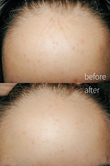 Эффективная маска Skin watchers Steam pore mask против черных точек и прыщей. Эффект после первого применения