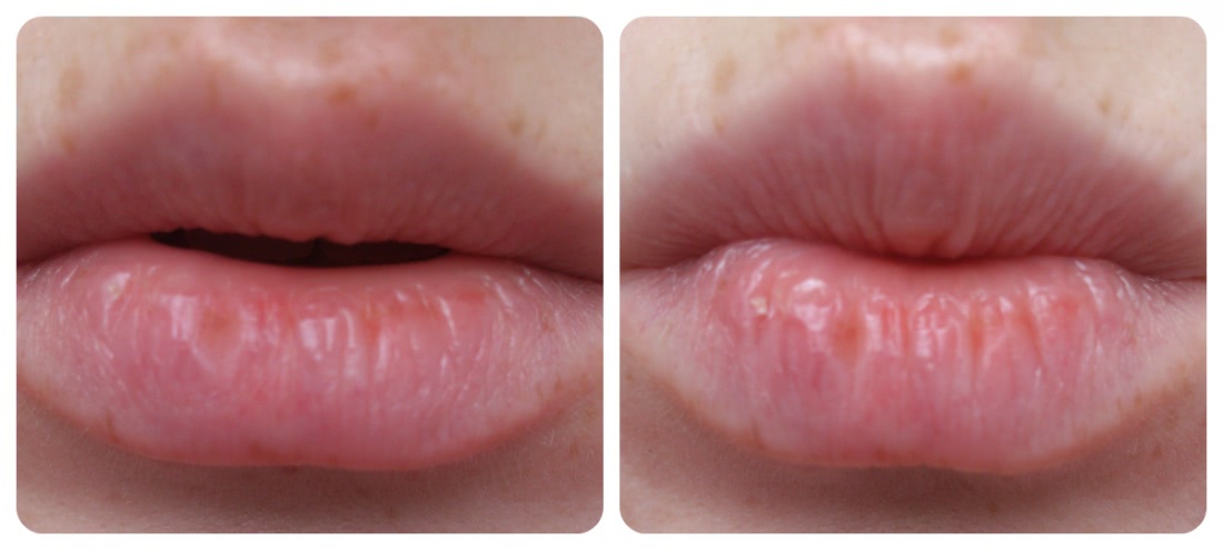 Губы после гигиенической помады. Помада для обветренных губ. Симптомы обветривания губ. Обветрилось вокруг губ.