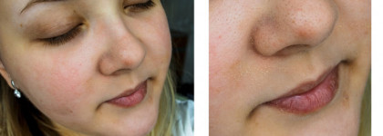 История о том, как эмульсия Avène TriAcneal Expert разгладила мою кожу