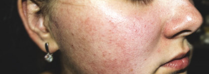 История о том, как эмульсия Avène TriAcneal Expert разгладила мою кожу