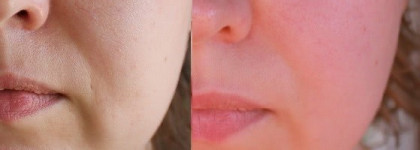 Lipo Oval от Meder