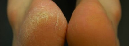 Использование гидроксикислот в регулярном уходе за кожей