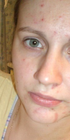 Жжение кожи после нанесения SPF | Косметиста