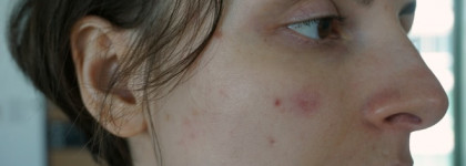 Лайфхак: вылечить кожу от вспышки акне за 5 дней