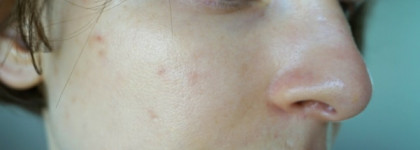 Лайфхак: вылечить кожу от вспышки акне за 5 дней