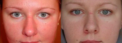 Матирование и избавление от красноты кожи