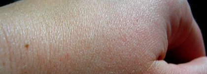 Еще немного о Дарфан (результат моего похода к косметологу Дарфан)