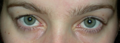 Еще немного о Дарфан (результат моего похода к косметологу Дарфан)