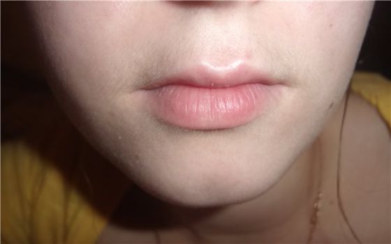 Усы у женщин над губами: причины и способы избавления