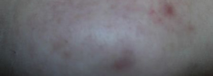 Маскирующий карандаш Clinique Anti-Blemish Solutions Сlearing Сoncealer