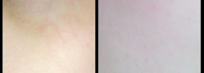 Куперозу нет! - La Roche Posay Rosaliac XL Riche