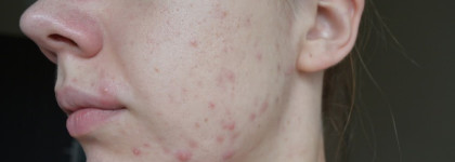 SVR Lysalpha Cicapeel Gel - Пилинг для жирной и проблемной кожи