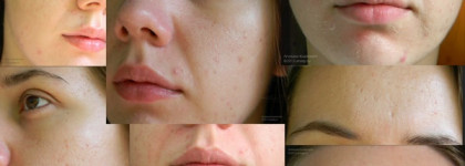 Мой большой кислотный опыт, часть 1: Салонный салициловый пилинг (описание, процесс, фото)