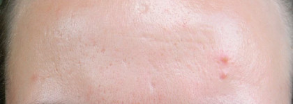 Мой большой кислотный опыт, часть 1: Салонный салициловый пилинг (описание, процесс, фото)