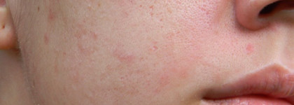 Мой большой кислотный опыт, часть 1: Салонный салициловый пилинг (описание, процесс, фото)