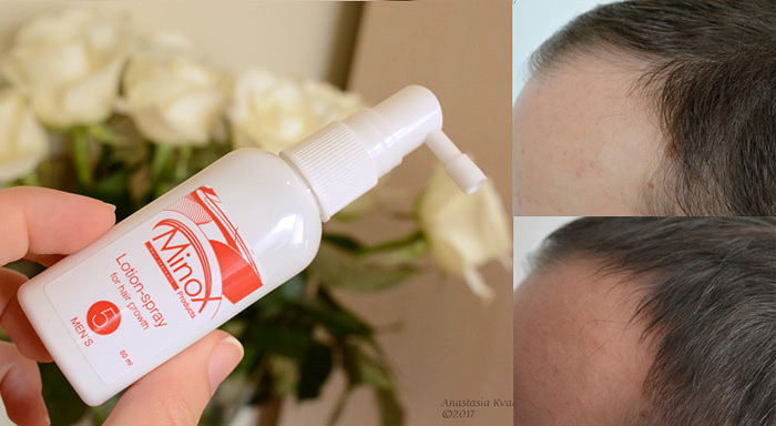 Лосьон Minox 5 против выпадения и для роста волос у мужчин | Отзывы  покупателей | Косметиста