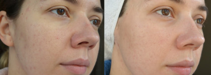 Lancome Visionnaire - Crescendo Peel Cream и Advanced Skin Corrector