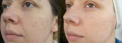 Lancome Visionnaire - Crescendo Peel Cream и Advanced Skin Corrector