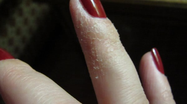 Аллергия у мастера маникюра. Аллергия на гель лак на руках. Аллергия на гель лак на пальцах. Аллергия на гель лак для ногтей.
