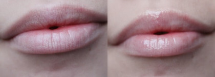 Almea Xlips EGF и Xlips Plumper
