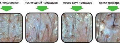 Nioxin Scalp renew пилинг для кожи головы