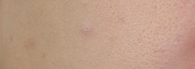 Lancome Effacernes Longue Tenue, Estee Lauder Ideal Light, Yves Rocher Корректор «Ноль Недостатков», Clinique Anti-Blemish Solutions Сlearing Сoncealer