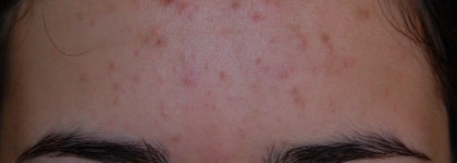 Успешная борьба с несовершенствами кожи