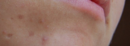 Успешная борьба с несовершенствами кожи