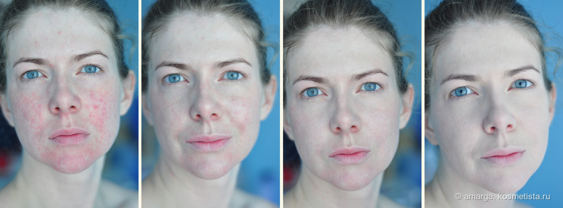 Как с помощью макияжа скрыть покраснение лица