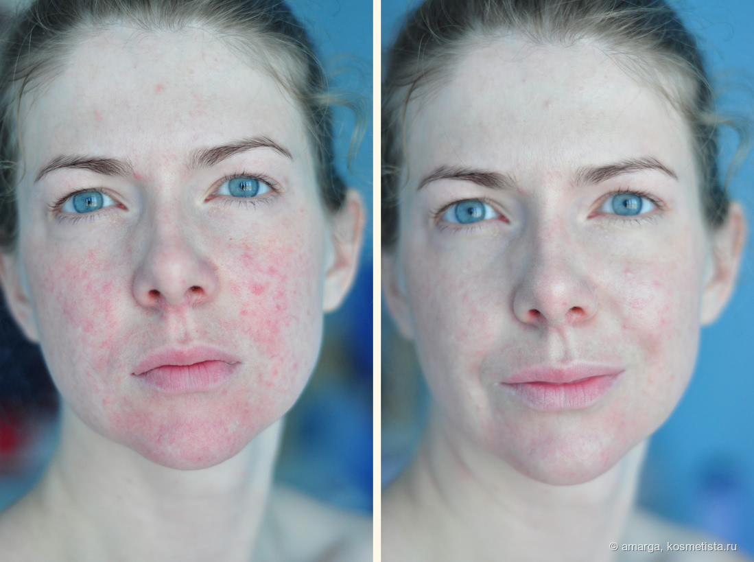 Как замаскировать сильные покраснения на лице? 3 этапа