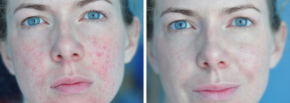 Как замаскировать сильные покраснения на лице? 3 этапа