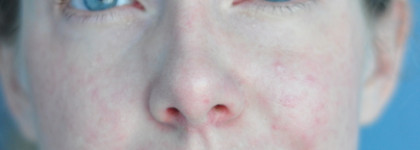 Как замаскировать сильные покраснения на лице? 3 этапа