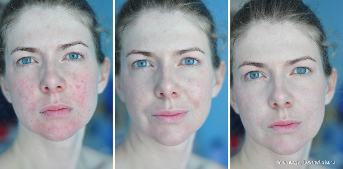 Как скрыть красные пятна на лице с помощью макияжа