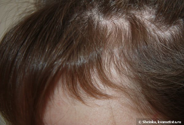 Система 4 лосьон от выпадения волос отзывы