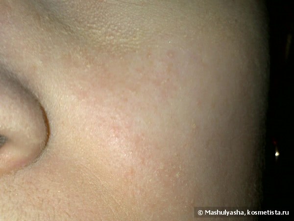 Аллергия у взрослых — как определить причину недуга