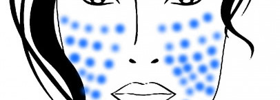 Третиноин. Шесть месяцев спустя