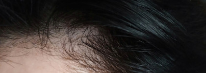 Как я борюсь с лысиной