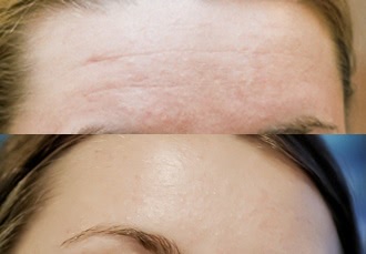 Frownies Facial Patches for Wrinkles on the Forehead & Between Eyes