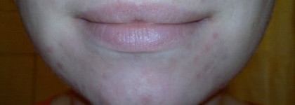 Уход за проблемной кожей (Часть 2): Proactiv Solution и  Vichy Normaderm