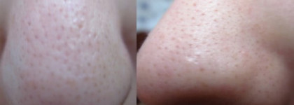 Шоковая терапия для моего носа или очищающие полоски "Пропеллер"