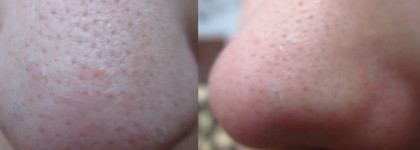 Шоковая терапия для моего носа или очищающие полоски "Пропеллер"