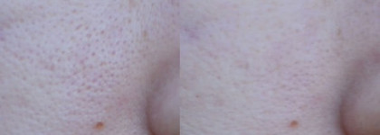 Clinique Pore Minimizer Instant Perfector #01 invisible light/naturel clair