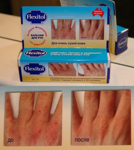 Бальзам для рук Flexitol – спасение для очень сухой кожи рук